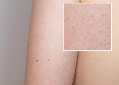Keratosis Pilaris i