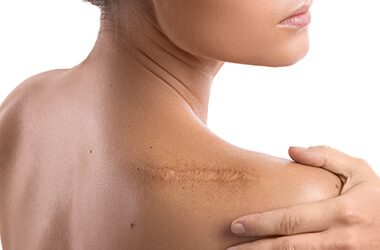 SCAR TREATMENTS