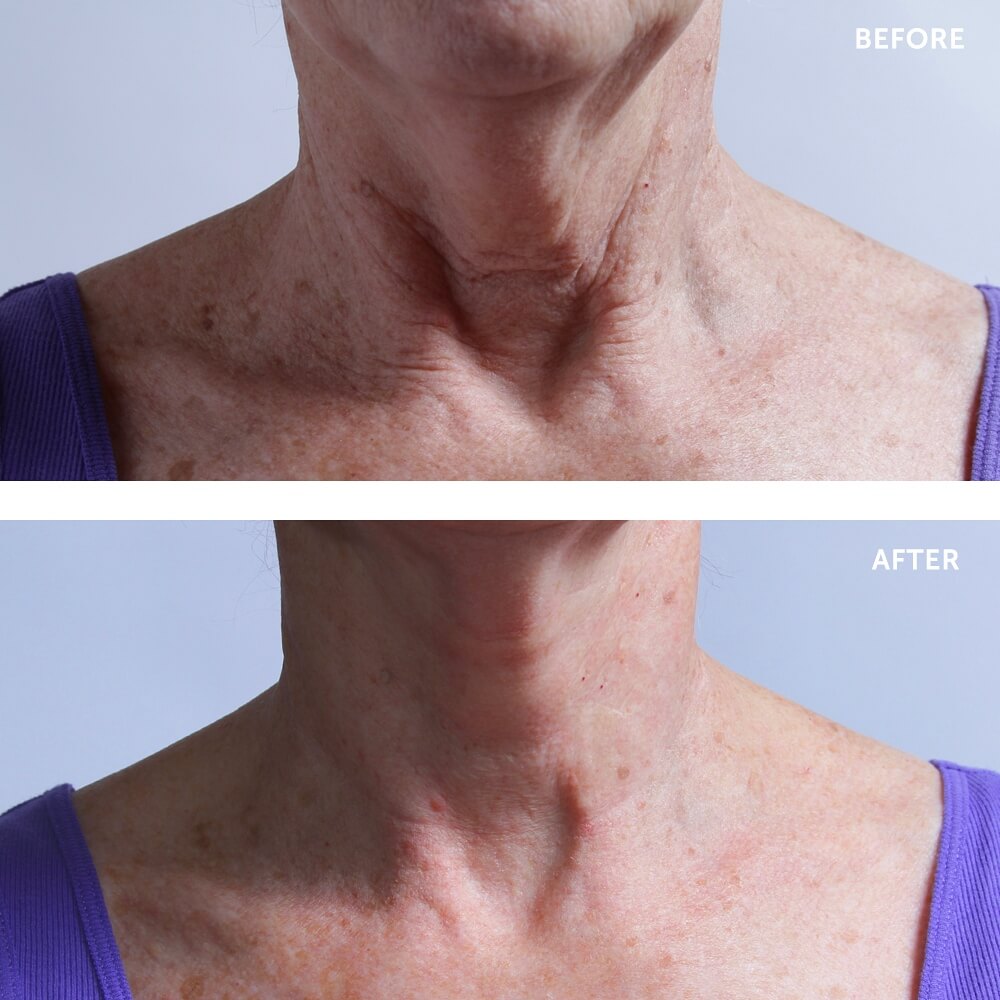 SilcSkin Collette Pads (For the Neck)