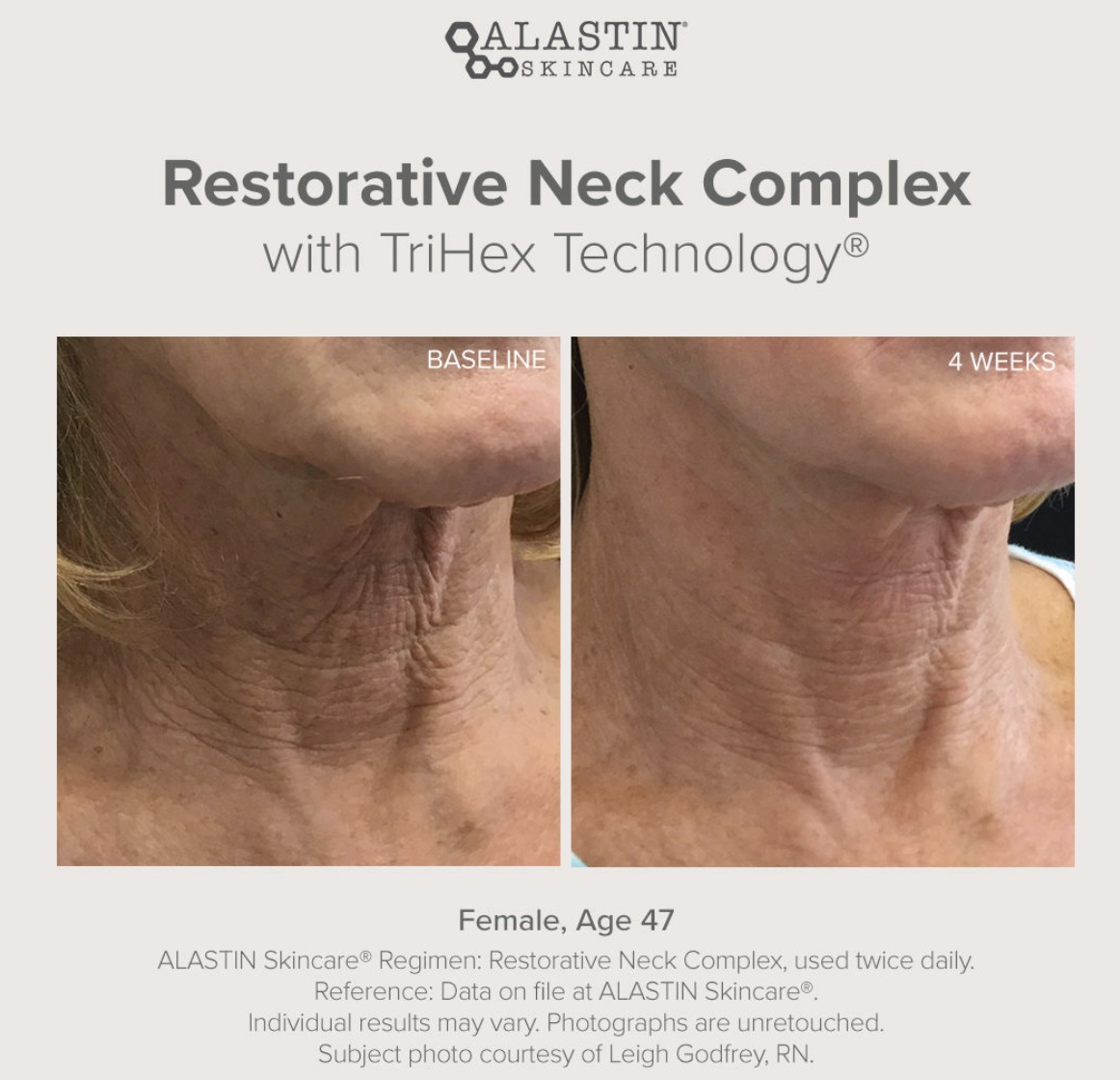 ALASTIN Skincare Restorative Neck Complex with TriHex Technology 50ml