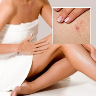 Ingrown hair